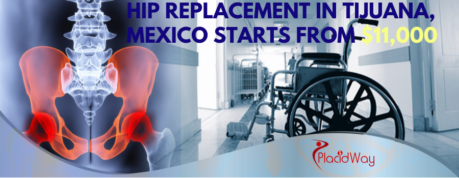 Hip Replacement Surgery in Tijuana, Mexico